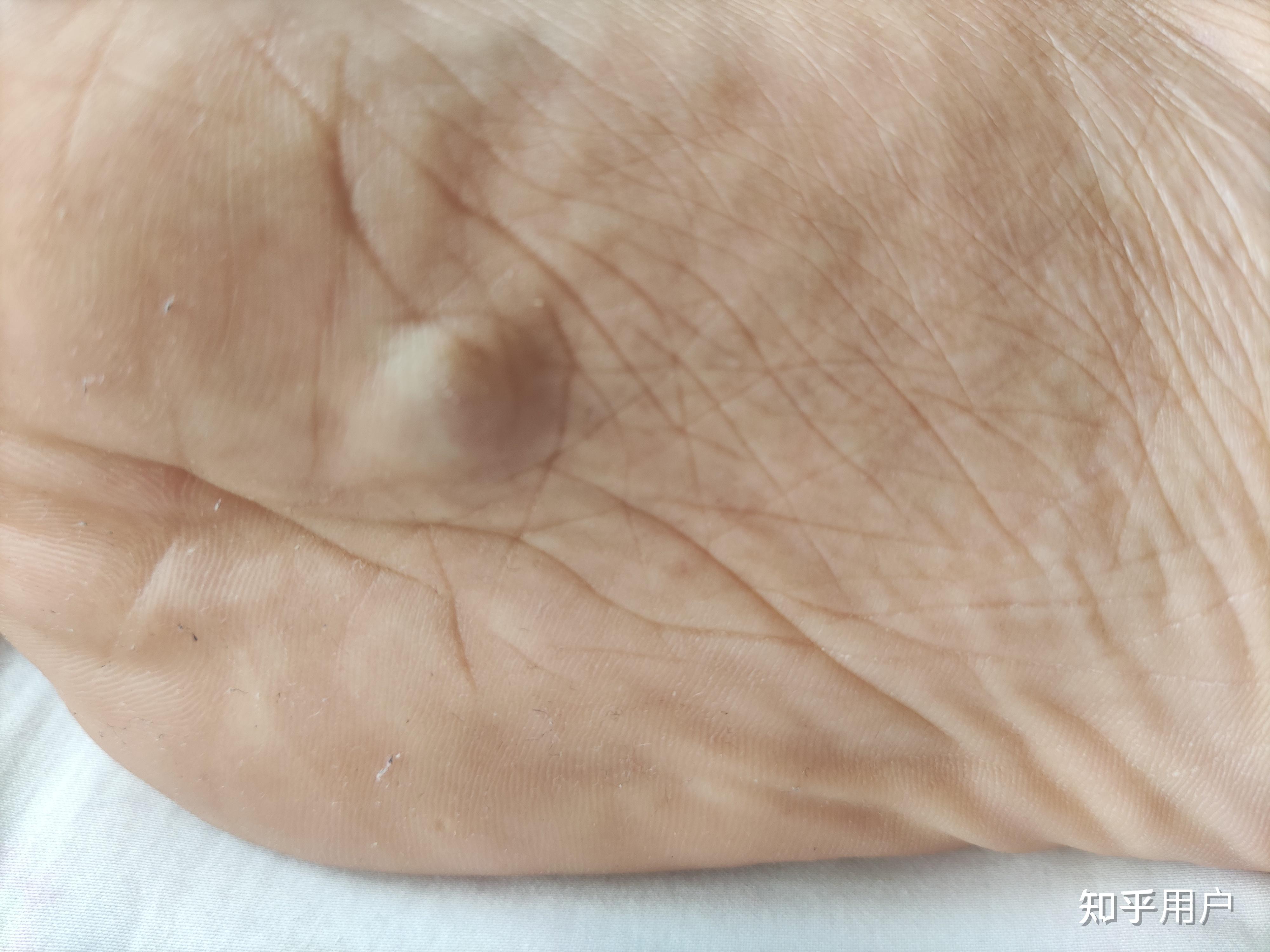 前脚掌长了个肿包,不碰不疼,按压会疼,是什么问题? - 知乎