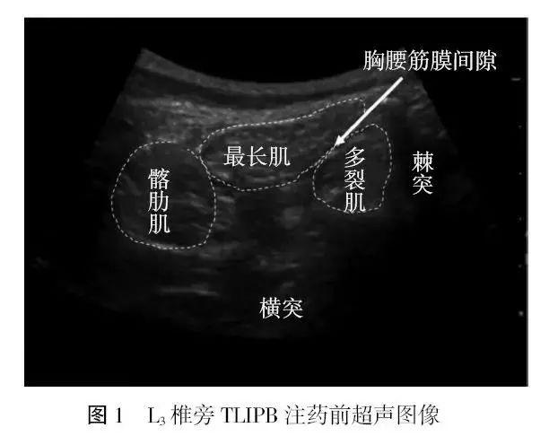 華聲臨床超聲可視化講座胸腰筋膜間平面阻滯對腰椎融合術後患者自控