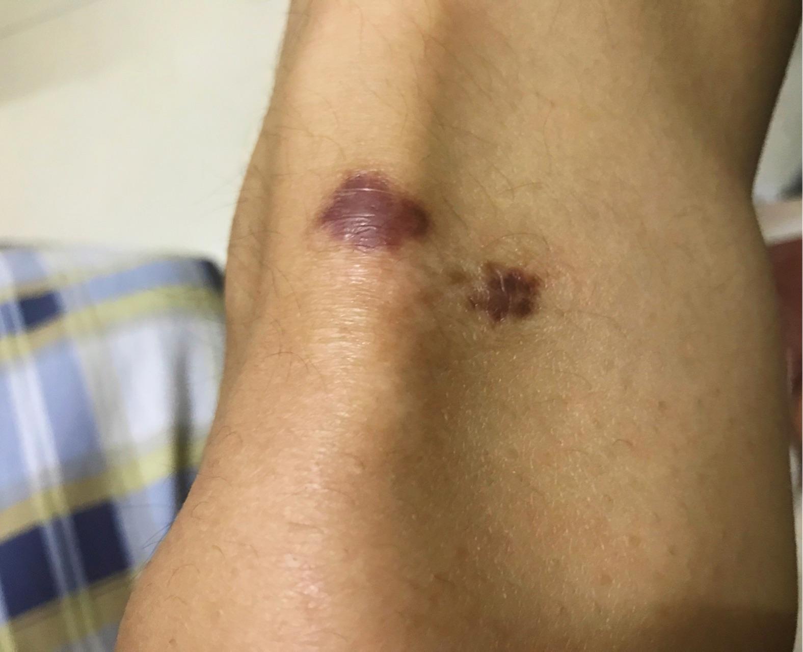 膝盖擦伤后疑似疤痕增生鼓鼓的平时是红色运动后会变紫