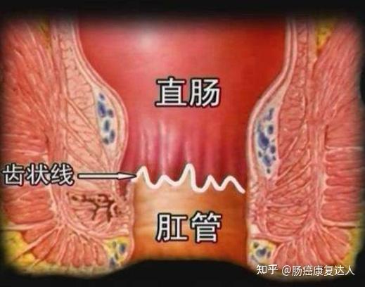 二,医生术后医嘱患者自己回家做扩肛的操作或者医生在患者复查指检时