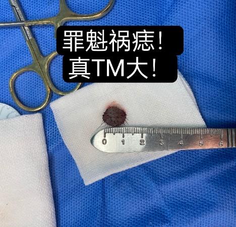 随着年龄越来越大,痣已经变成5mm的肉痣呈棕色,这种情况怎么解释?