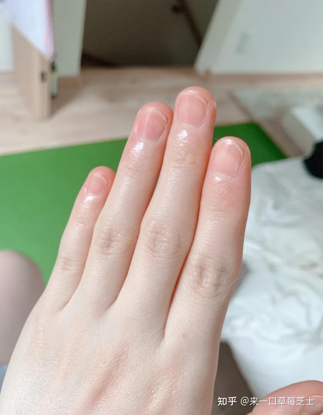 女生手指关节发黑何解决? - 知乎