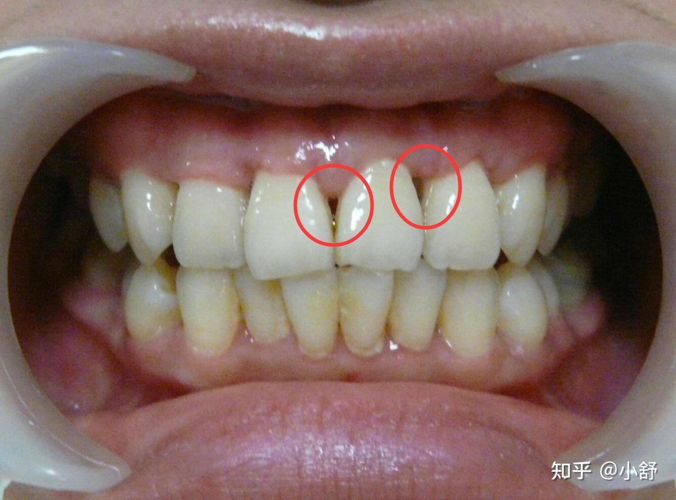 为什么会牙龈萎缩?