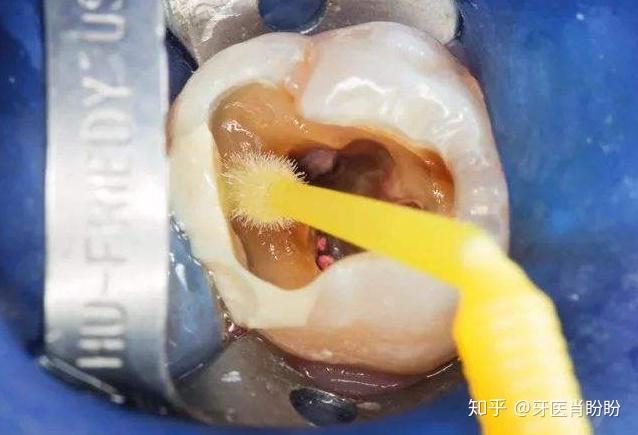 根管治疗杀神经前的钻牙步骤就是开髓吗? - 知乎