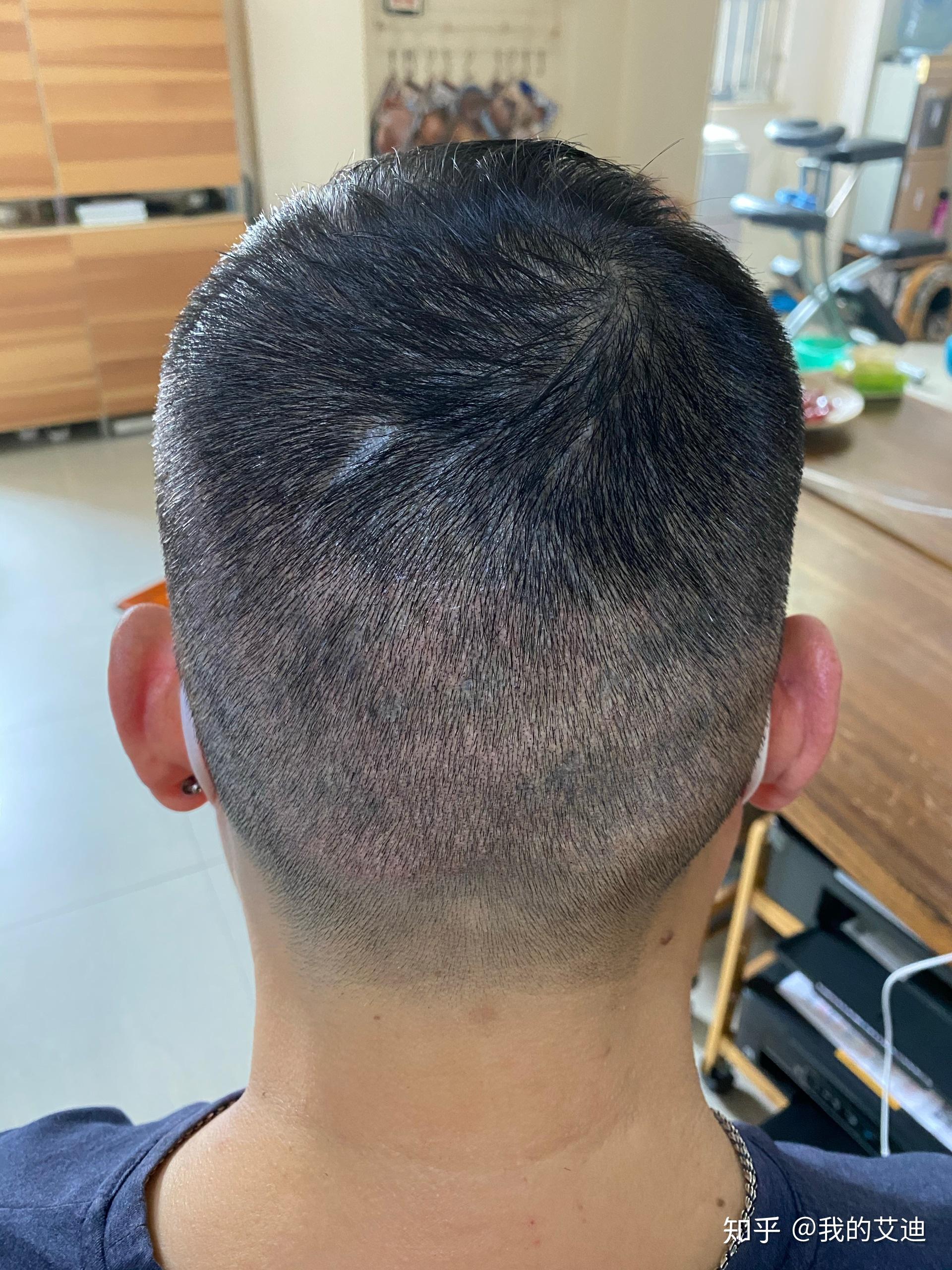 植发微针留下的取毛囊小疤痕纹发修饰效果很好