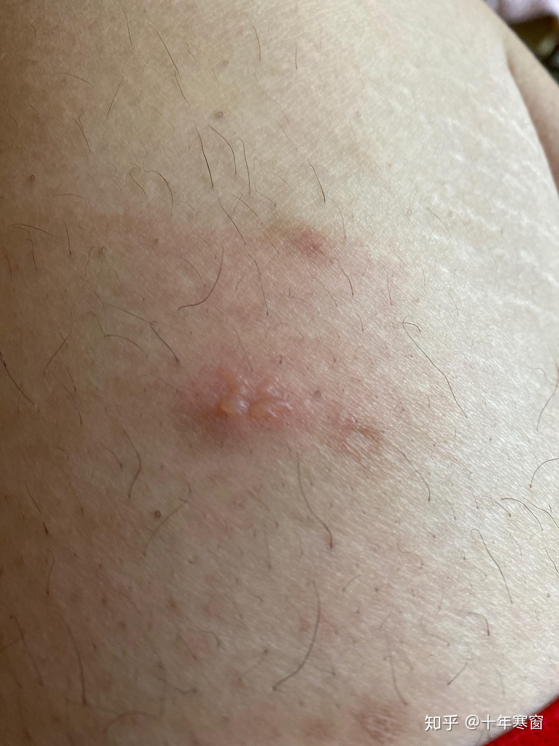 腿上起了个小水泡?