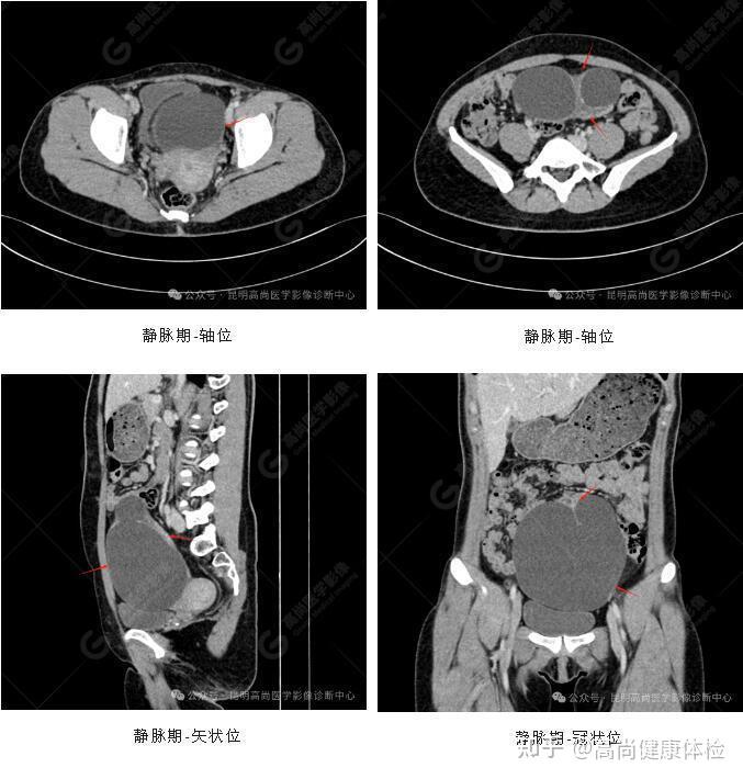 23岁女性左侧卵巢浆液性囊腺瘤一例