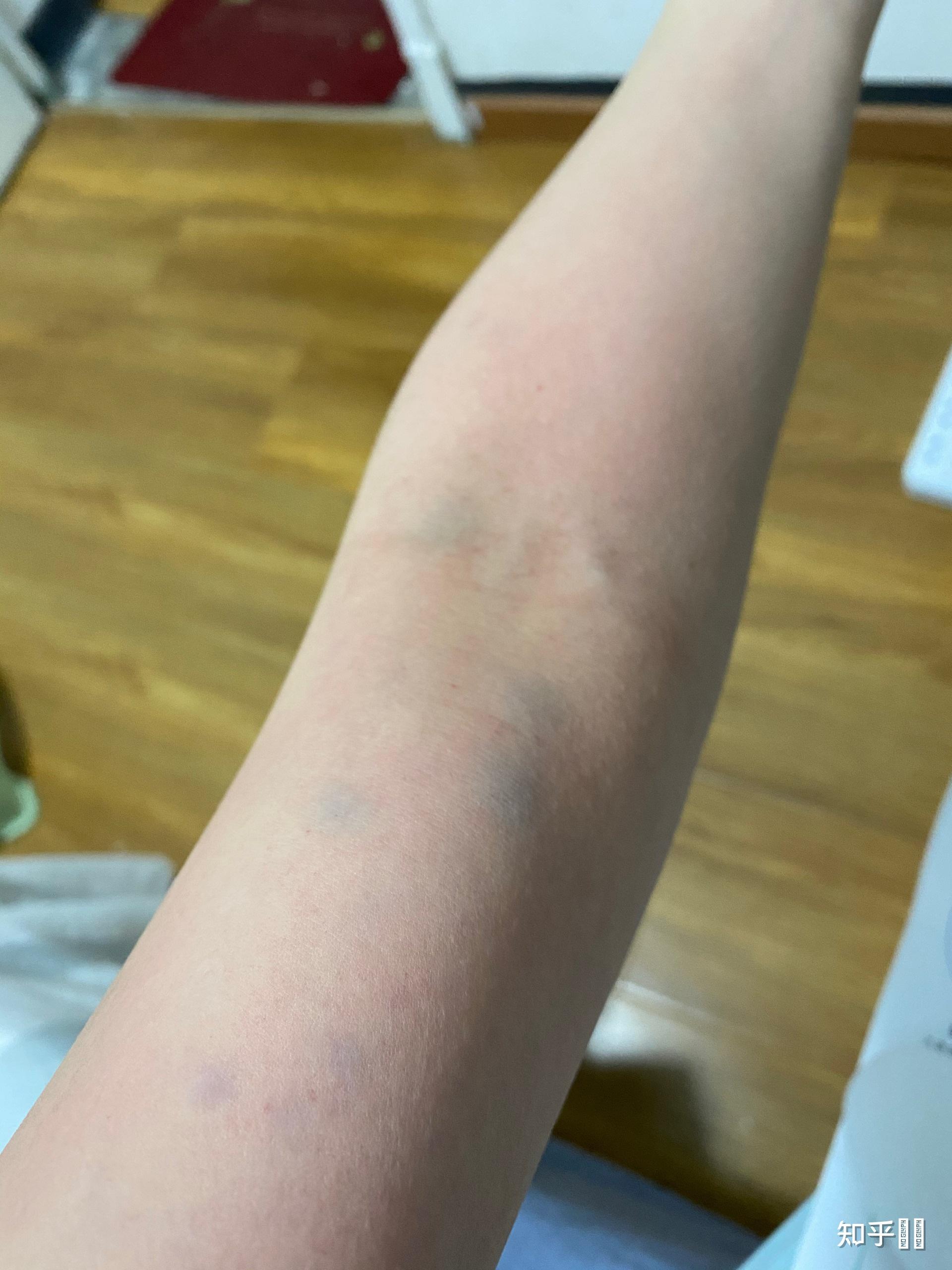 拍痧时如何知道拍出的是痧还是皮下出血?