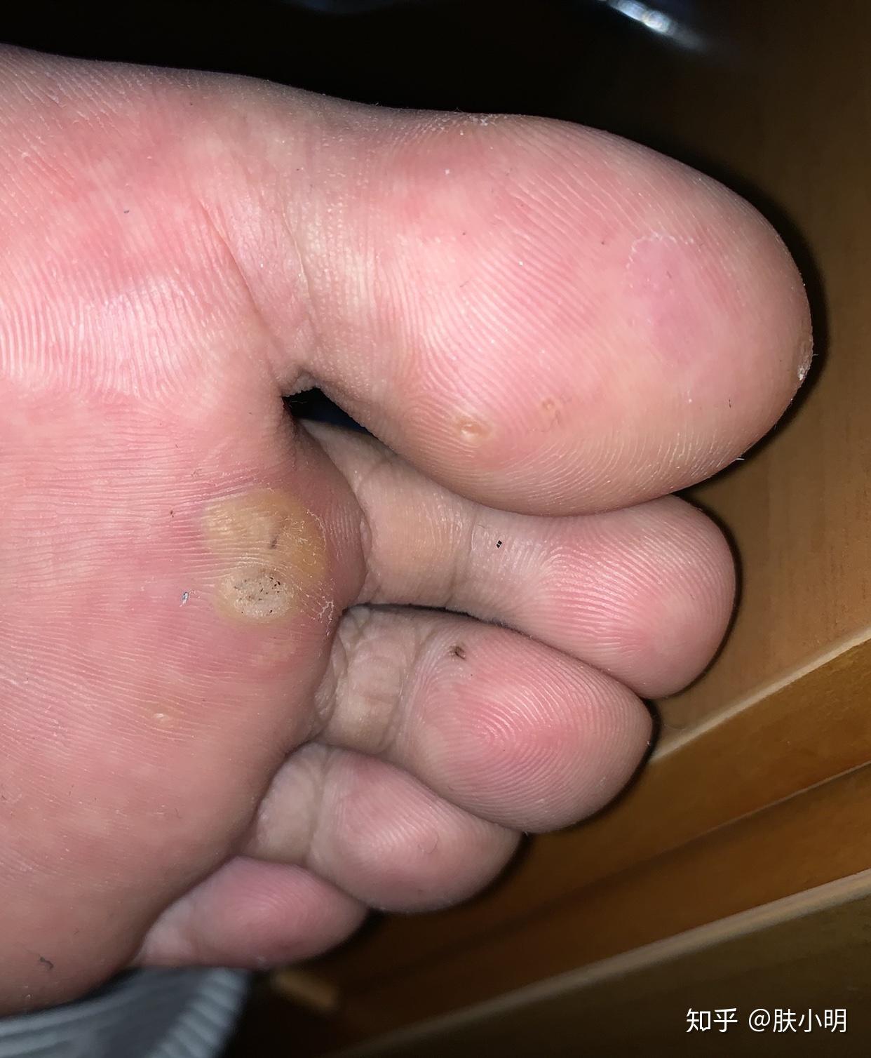 这是趾疣嘛求大神治疗办法用激光说会反复到底怎么办