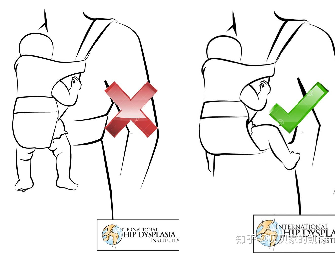 警惕臀纹不对称髋关节发育不良ddh到底是什么