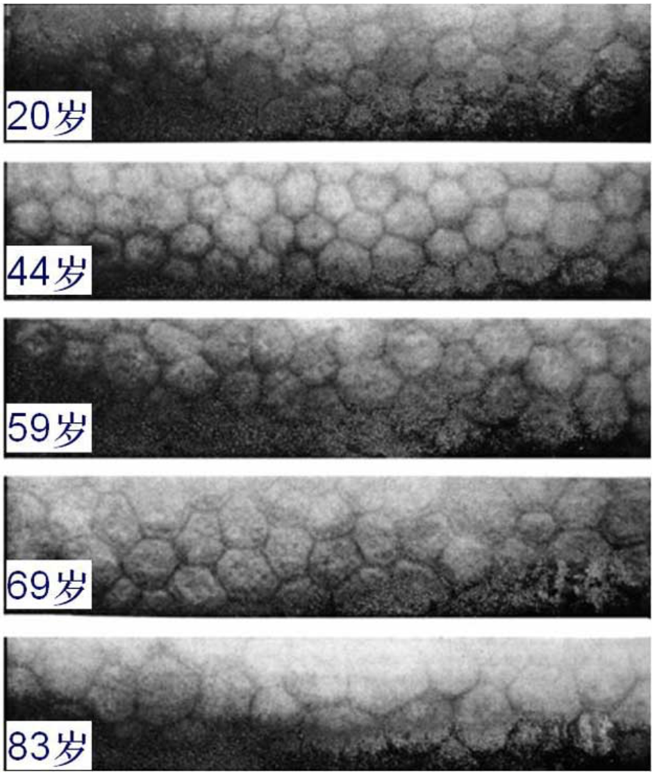 如果从20岁开始戴软性隐形眼镜10年后角膜内皮细胞密度相当于60岁的