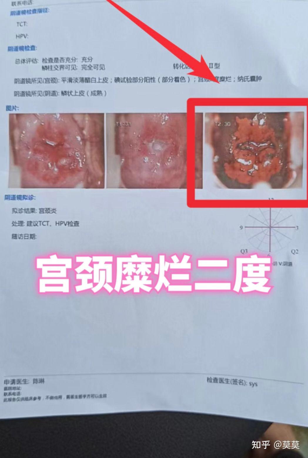 一度宫颈糜烂图片图片