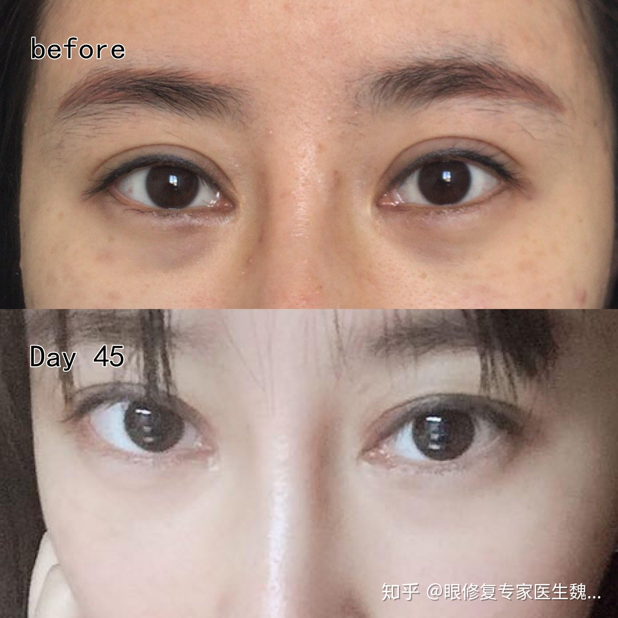 魏志香说宽双眼皮如何变窄