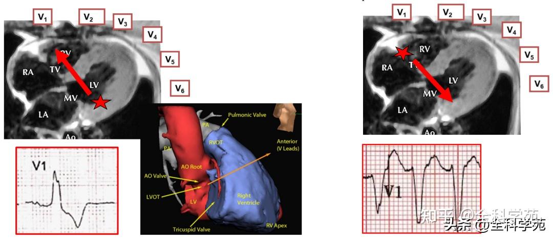 心电图笔记37：室性心律失常起源的心电图定位 - 知乎