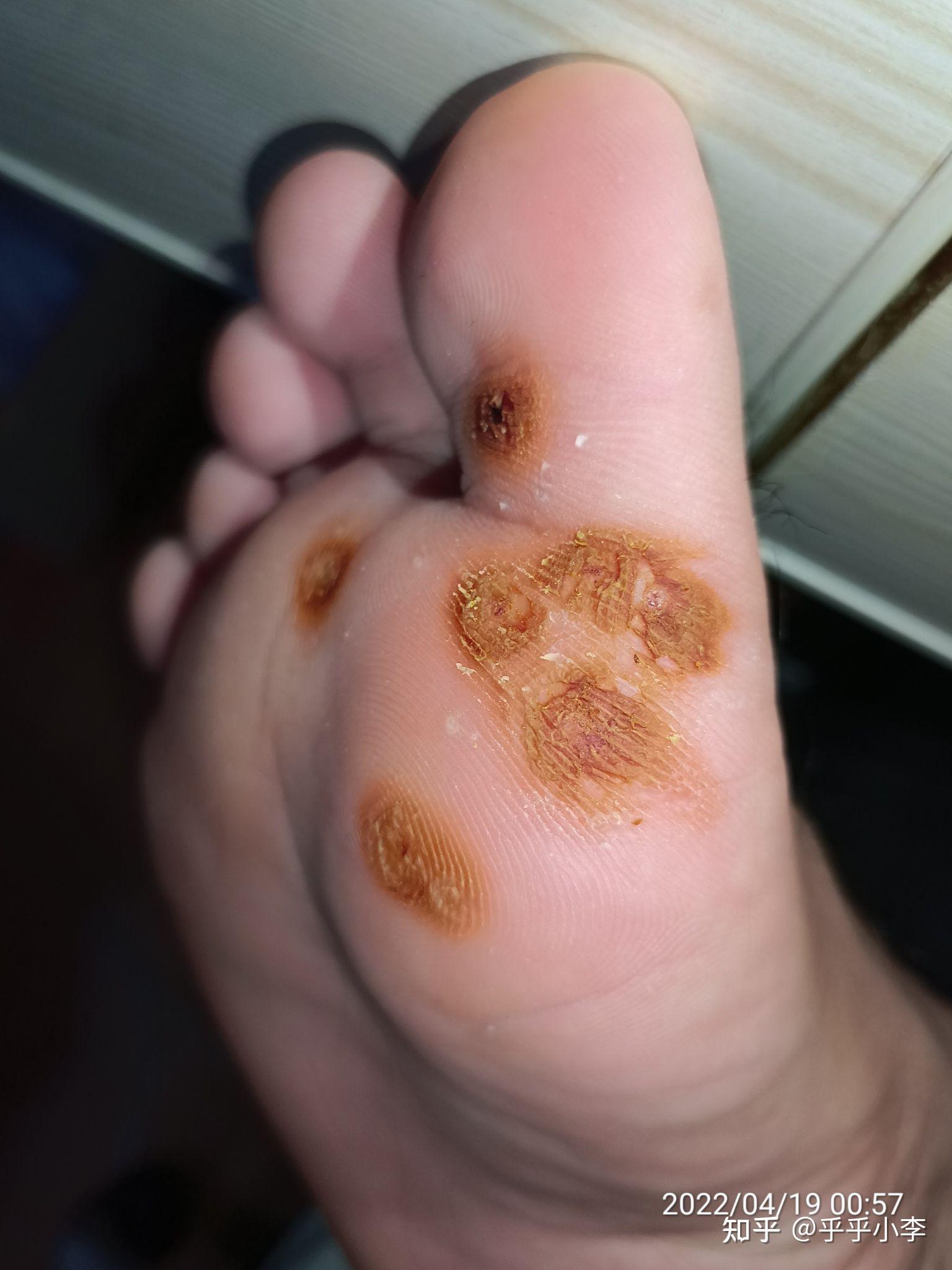 10%浓碘酊治疗跖疣 - 知乎