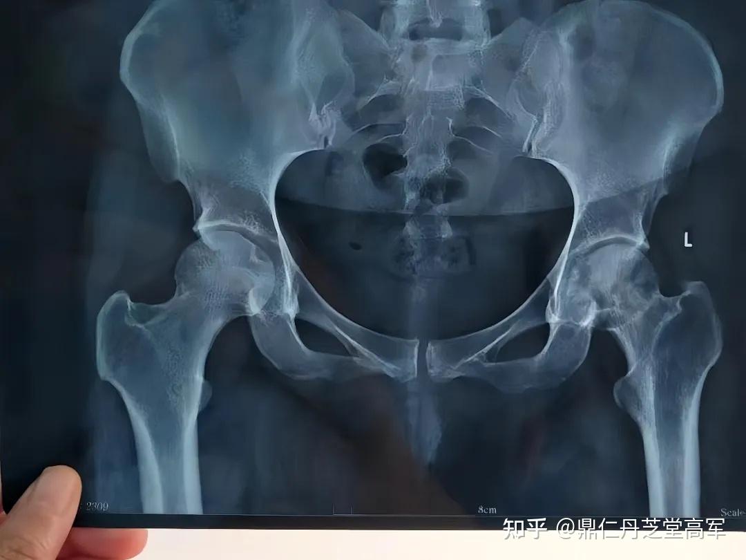 各位大神请问股骨头坏死这方面的研究世界上在做吗有进展吗