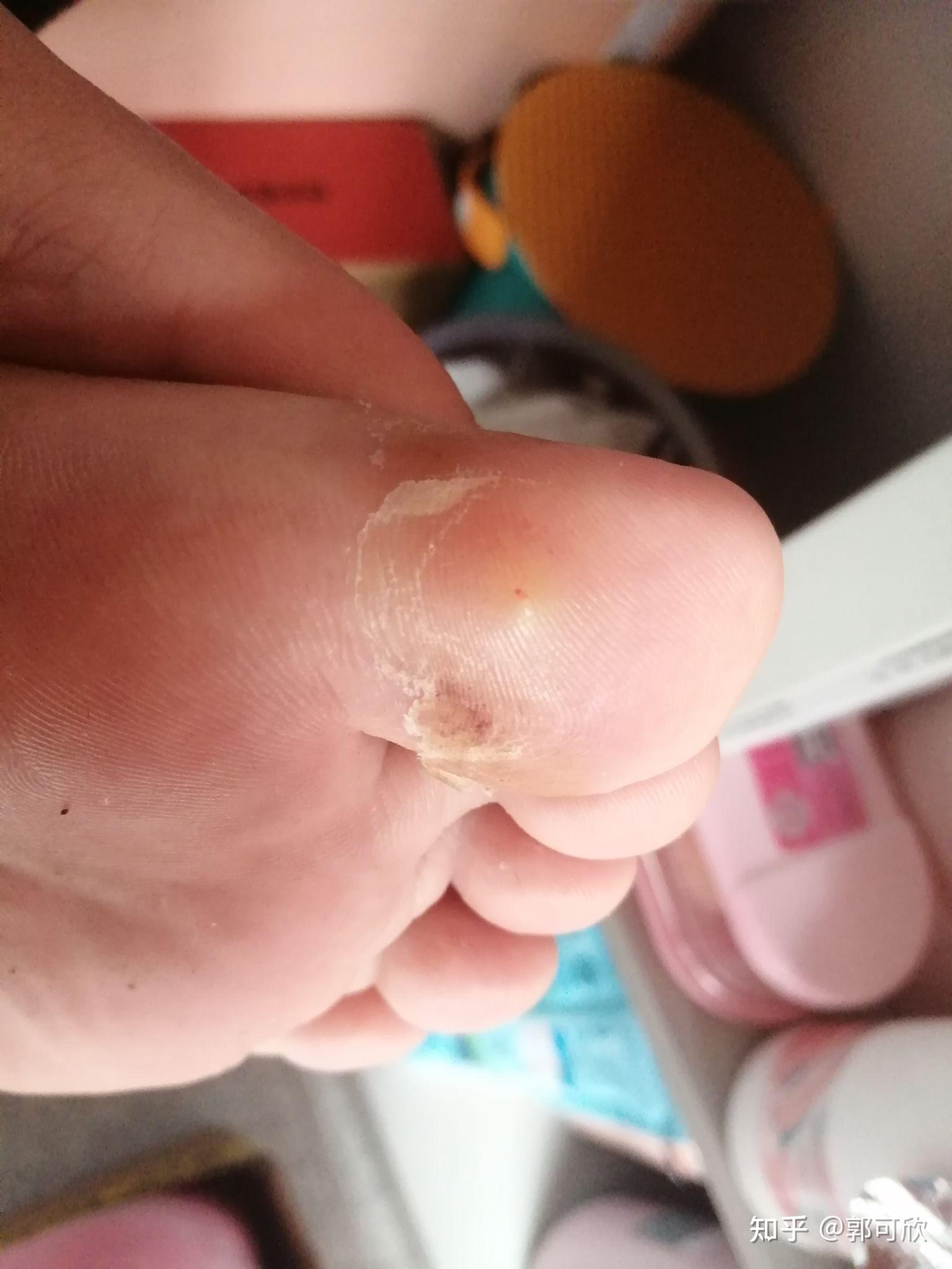 液氮冷冻鸡眼治疗贴. - 知乎