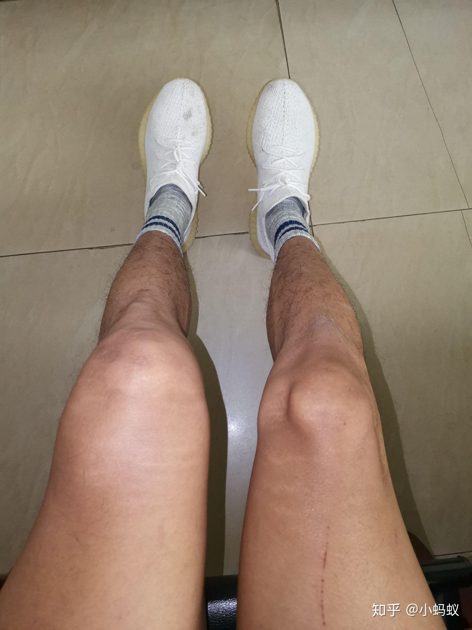 膝盖积液是一种怎样的体验