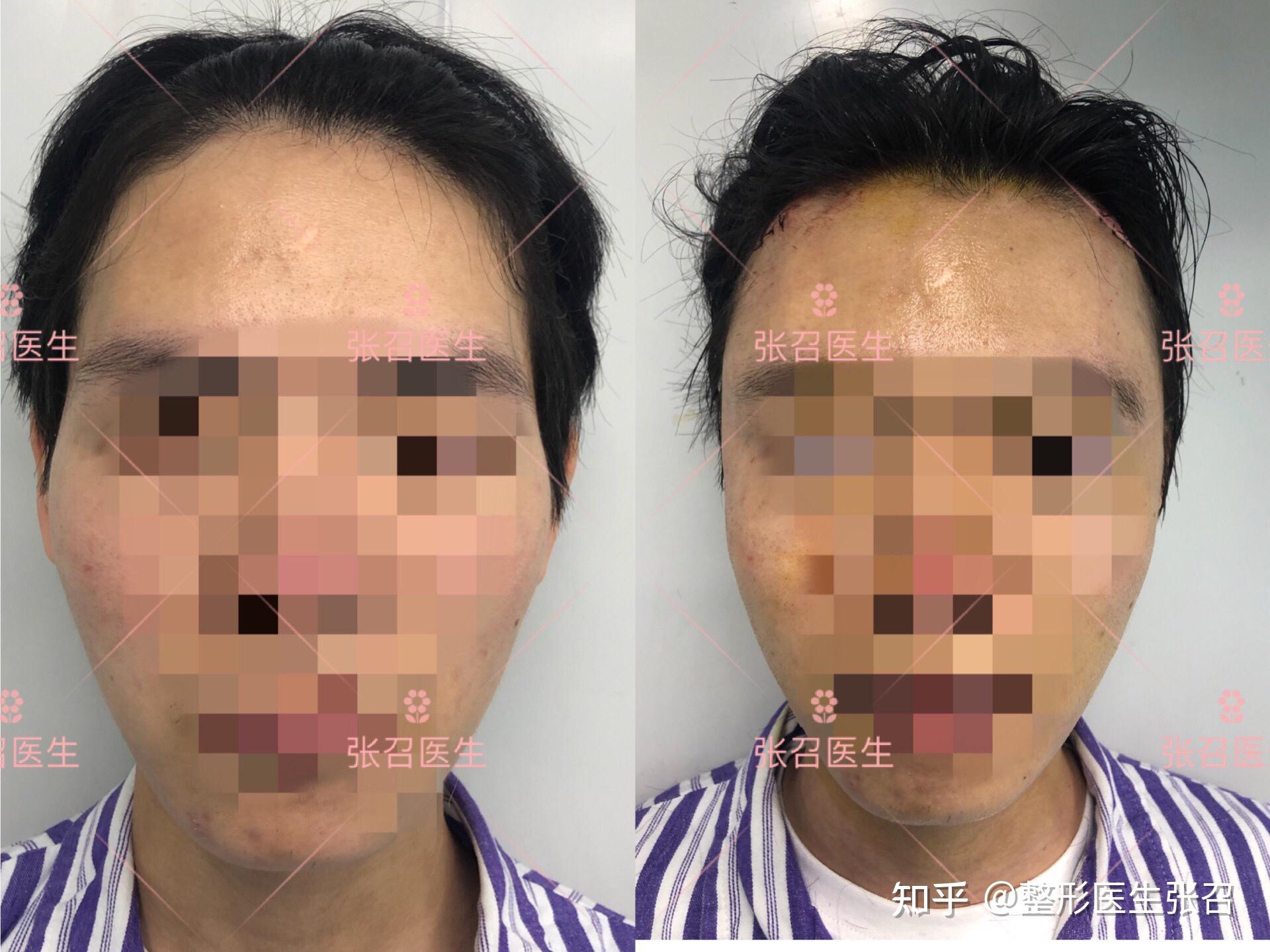 知道额颞角在哪里吗? - 知乎