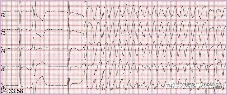 (2)心电图表现:心室扑动呈正弦波图型,波幅大而规则,频率150~300次