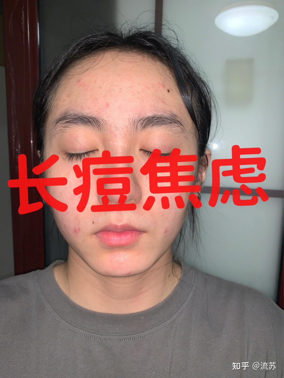 99%的人都不知道长痘的原因，傻瓜式祛痘攻略 - 知乎
