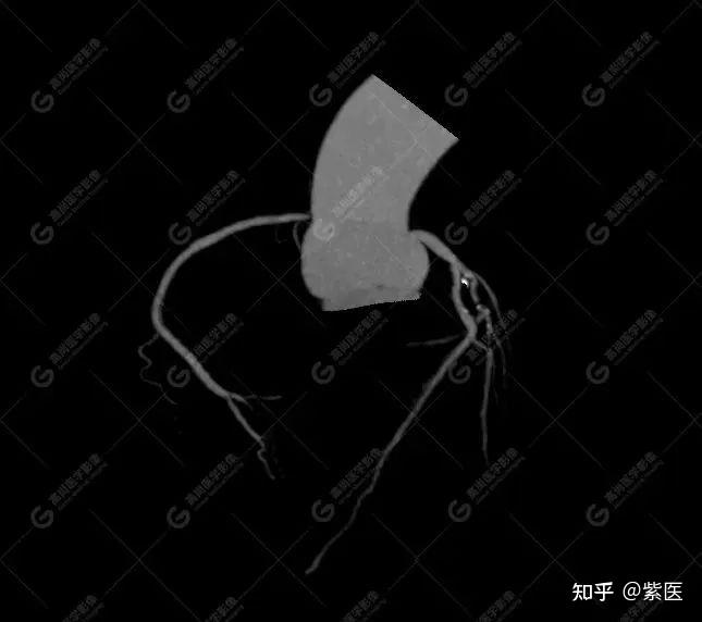 心脏血管“高清CT”:读懂冠脉CTA,从检查到报告全指南 - 知乎