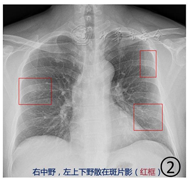 什么是高密度结节影 v2-442cfd10b08fe0e2ce44a7ec84e06160_r.jpg