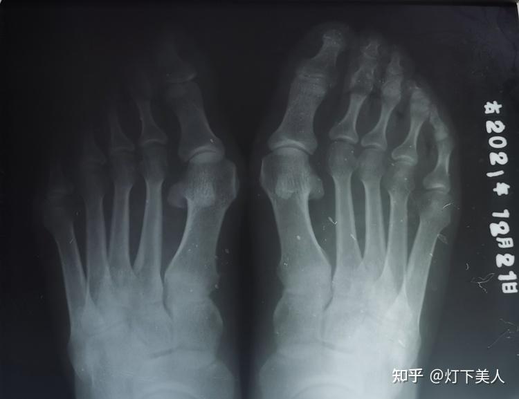 洛阳大脚骨磨人的大脚骨必须做手术吗