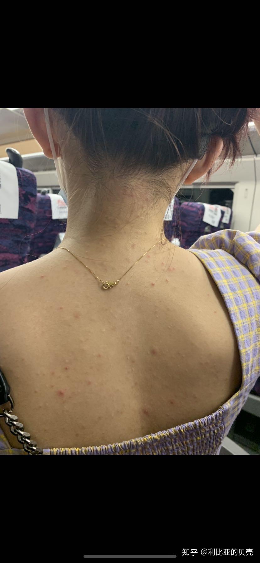 背上得了毛囊炎要多久才能好