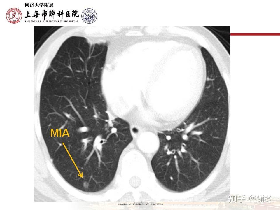 表現為磨玻璃結節磨玻璃影的微浸潤腺癌mia