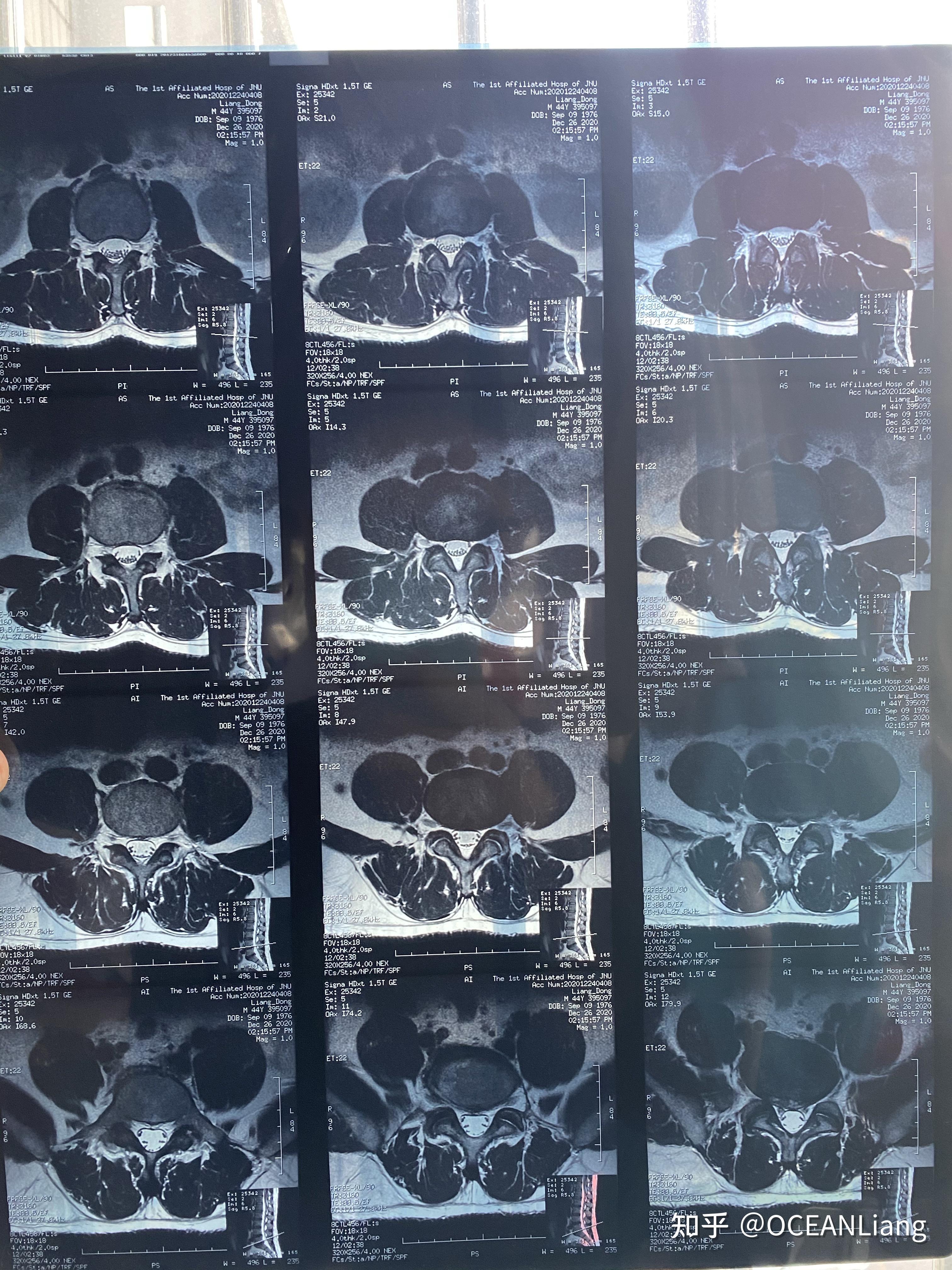 腰椎磁共振片子图片