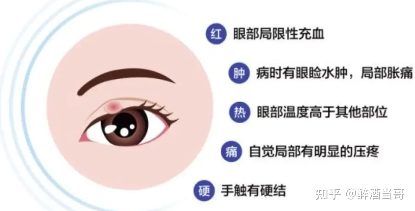 为什么你总是长麦粒肿？如何预防以及快速缓解麦粒肿？一文读懂！