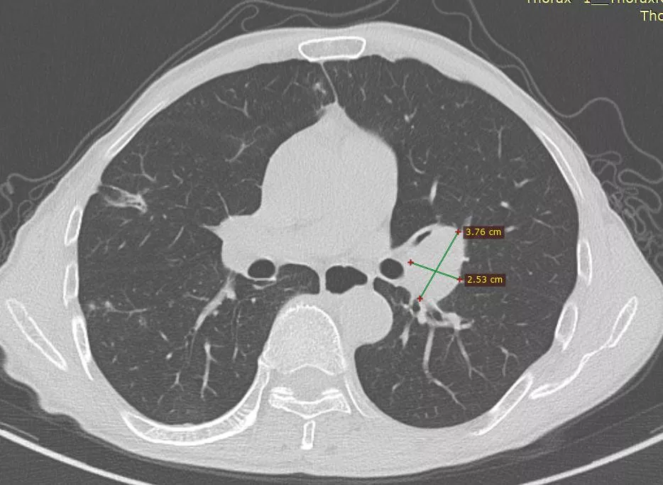 大医小癌答疑回顾二
