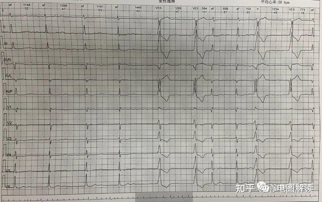 室性逸搏心律图片图片