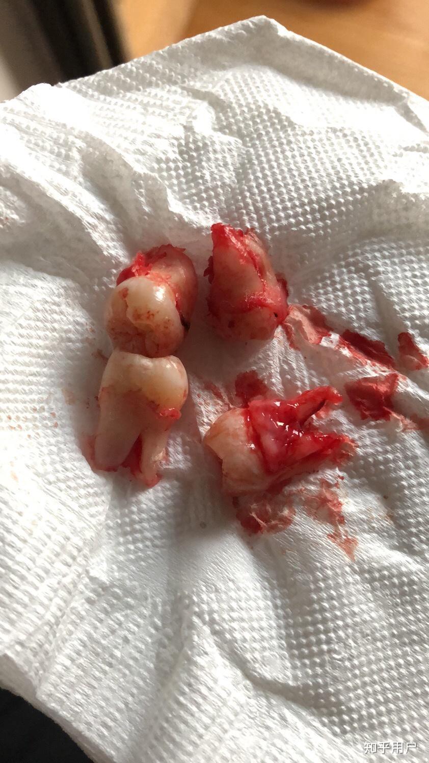 一次拔四颗智齿的体验