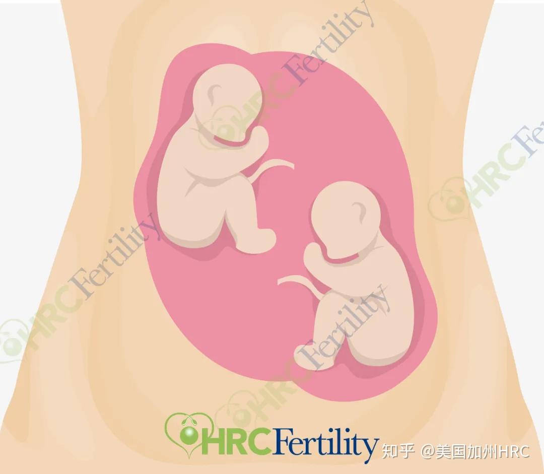 HRC课堂| 你是不是也想要双胞胎/龙凤胎？安排！不过风险早知道哦！ - 知乎