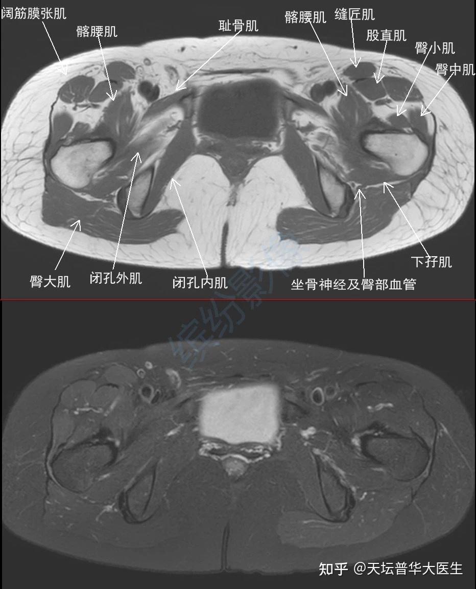 髋关节MRI解剖 - 知乎