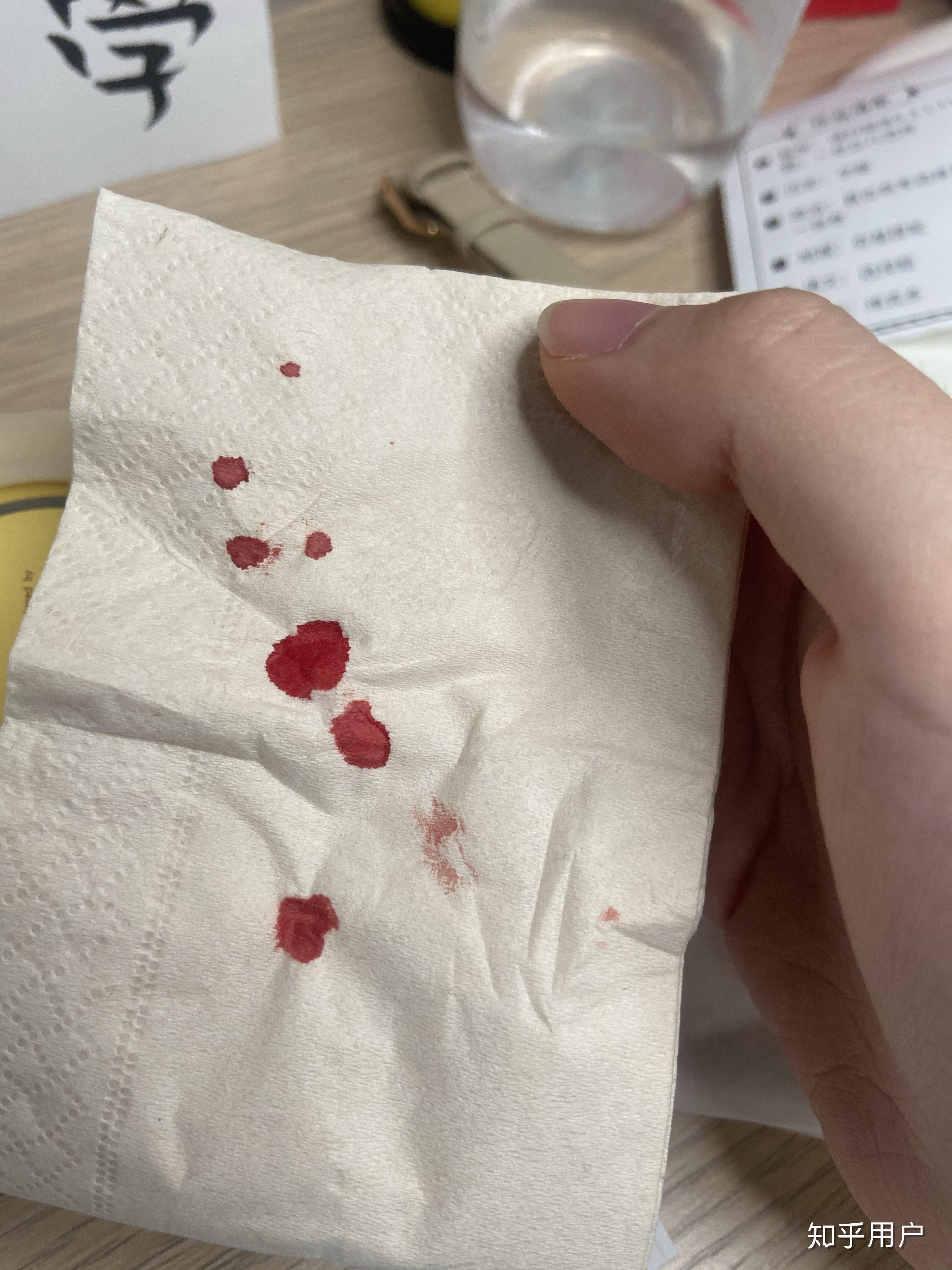 手指被订书针扎破了会得破伤风吗