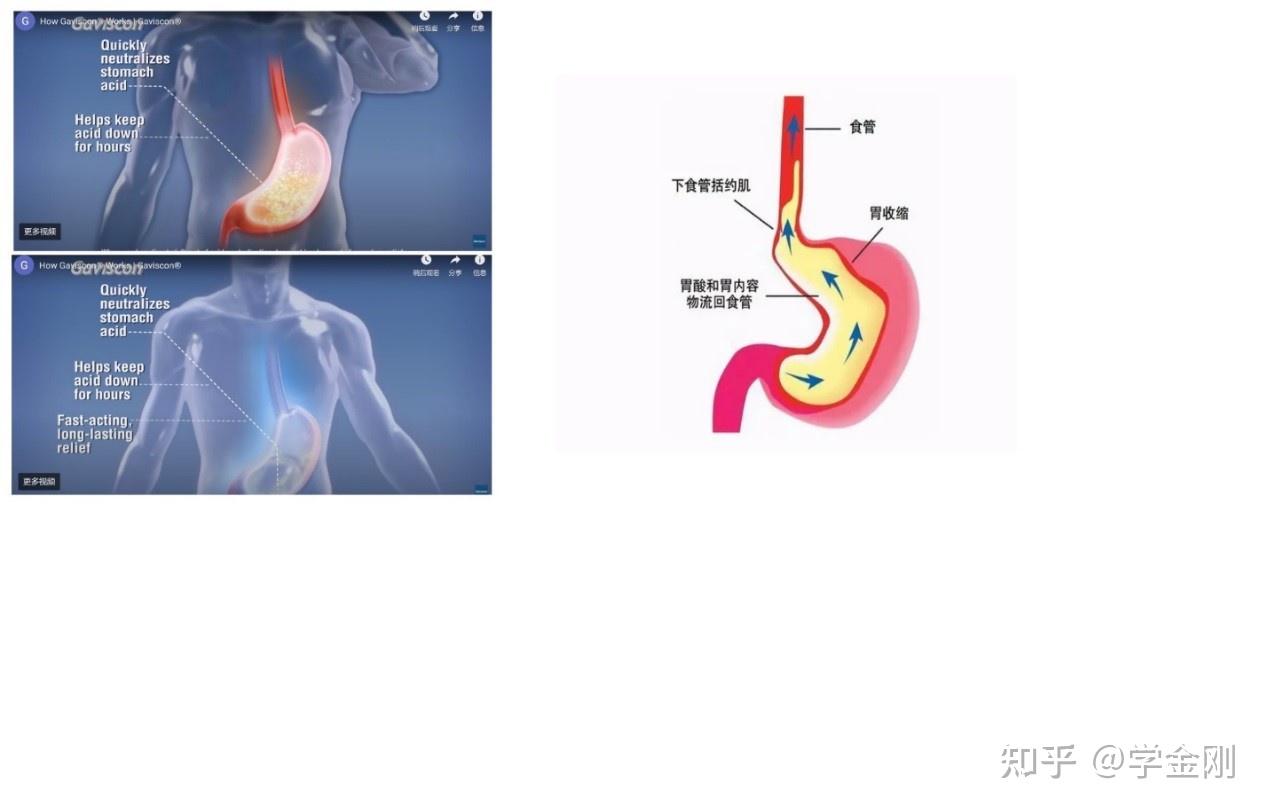 专业医生科普：胃部不适反胃酸怎么办？如何缓解胃胀气、消化不良 - 知乎