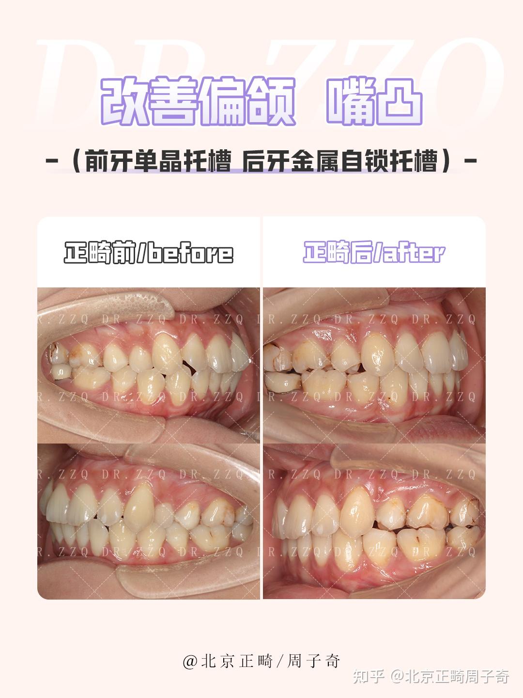 偏颌是一种什么体验? - 知乎