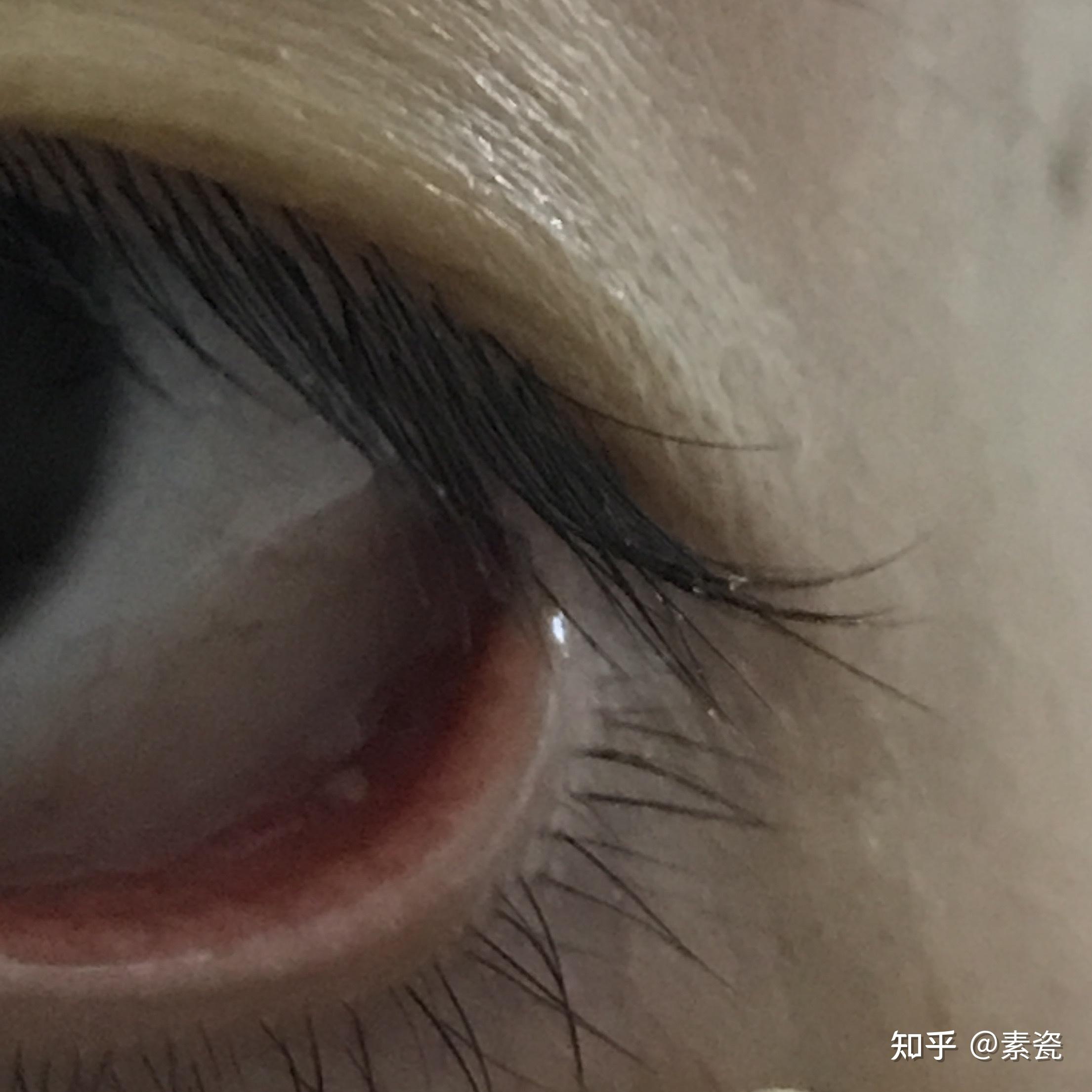 滤泡性结膜炎如何能有效治疗之前会怕光流眼泪眼干涩疼痛现在这些症状