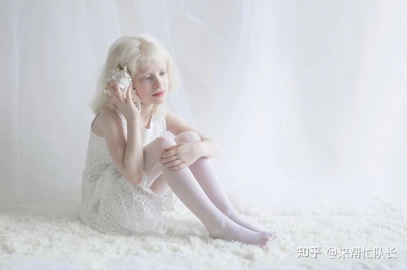 白化病的病人可以拥有正常人一样的寿命,只是他们不能过度暴露在紫外