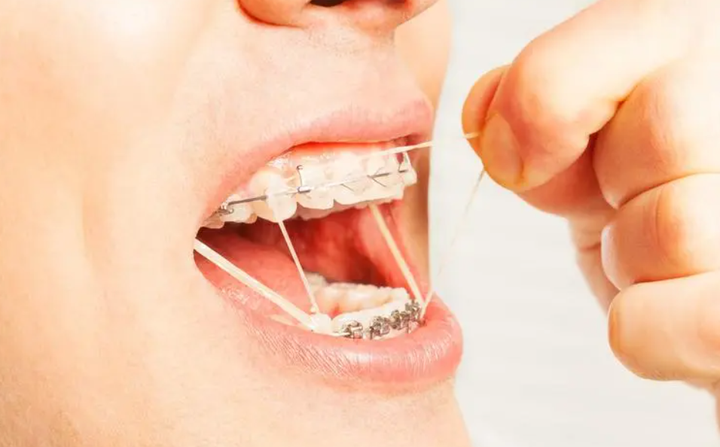 正畸牵引之挂皮筋,有啥作用?