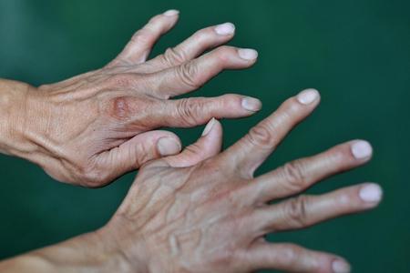 类风湿关节炎科学规范治疗让你摆脱致残率90的噩梦