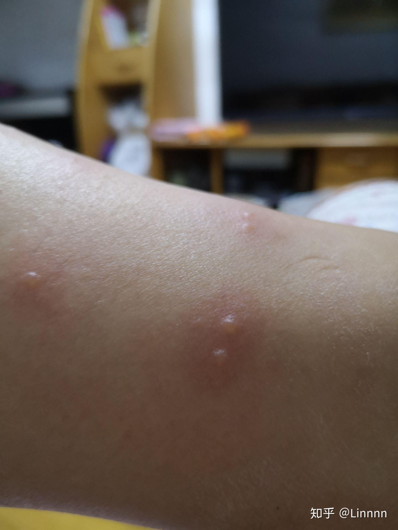 被跳蚤咬的全身都是包是什么样的感受