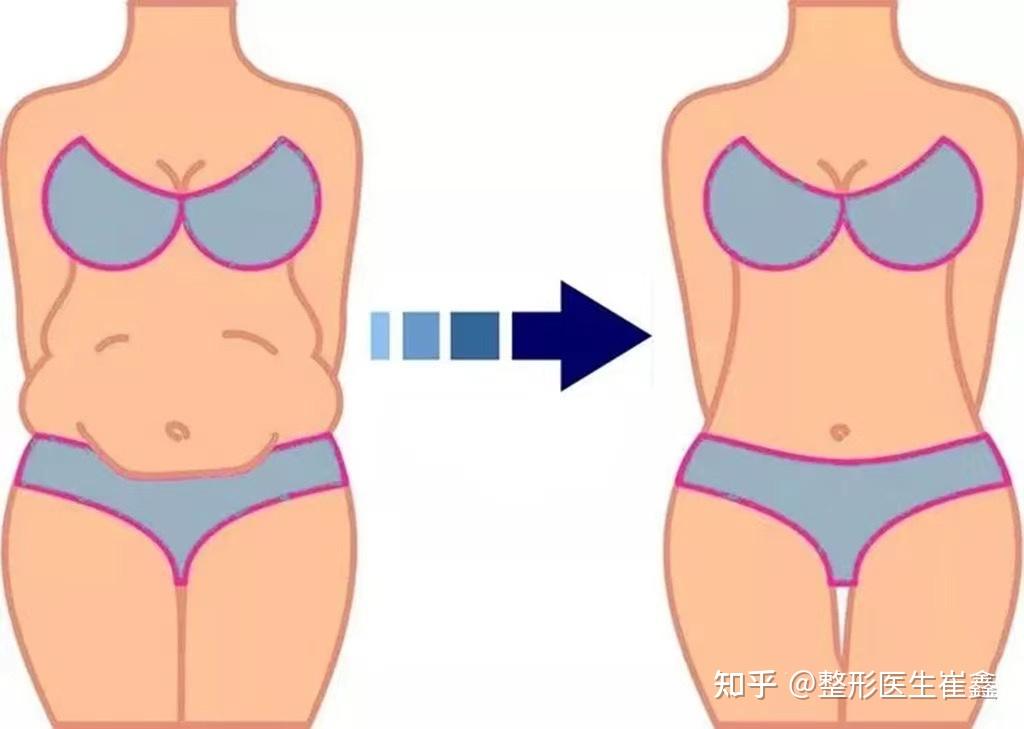 在y经期腹壁成型到底会有什么影响