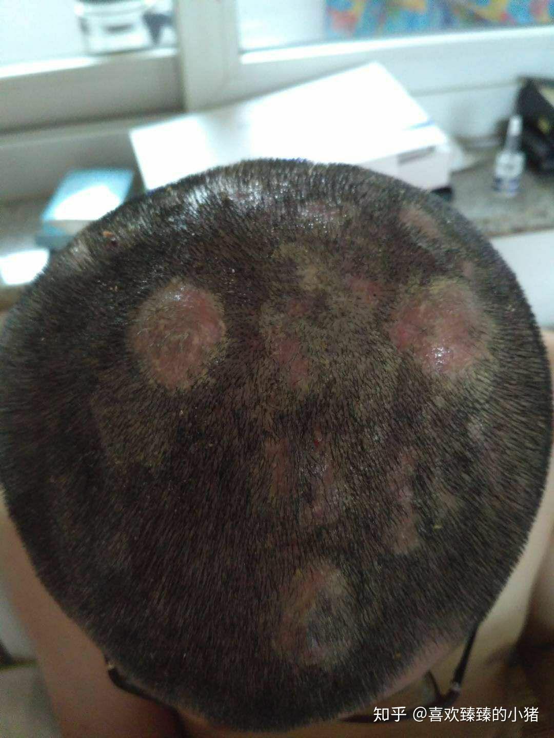 头部穿掘性毛囊炎