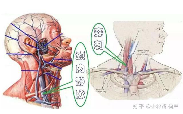 门奇静脉断流术图片