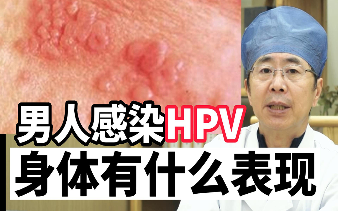 男性究竟會不會感染hpv52?有什麼症狀? - 知乎