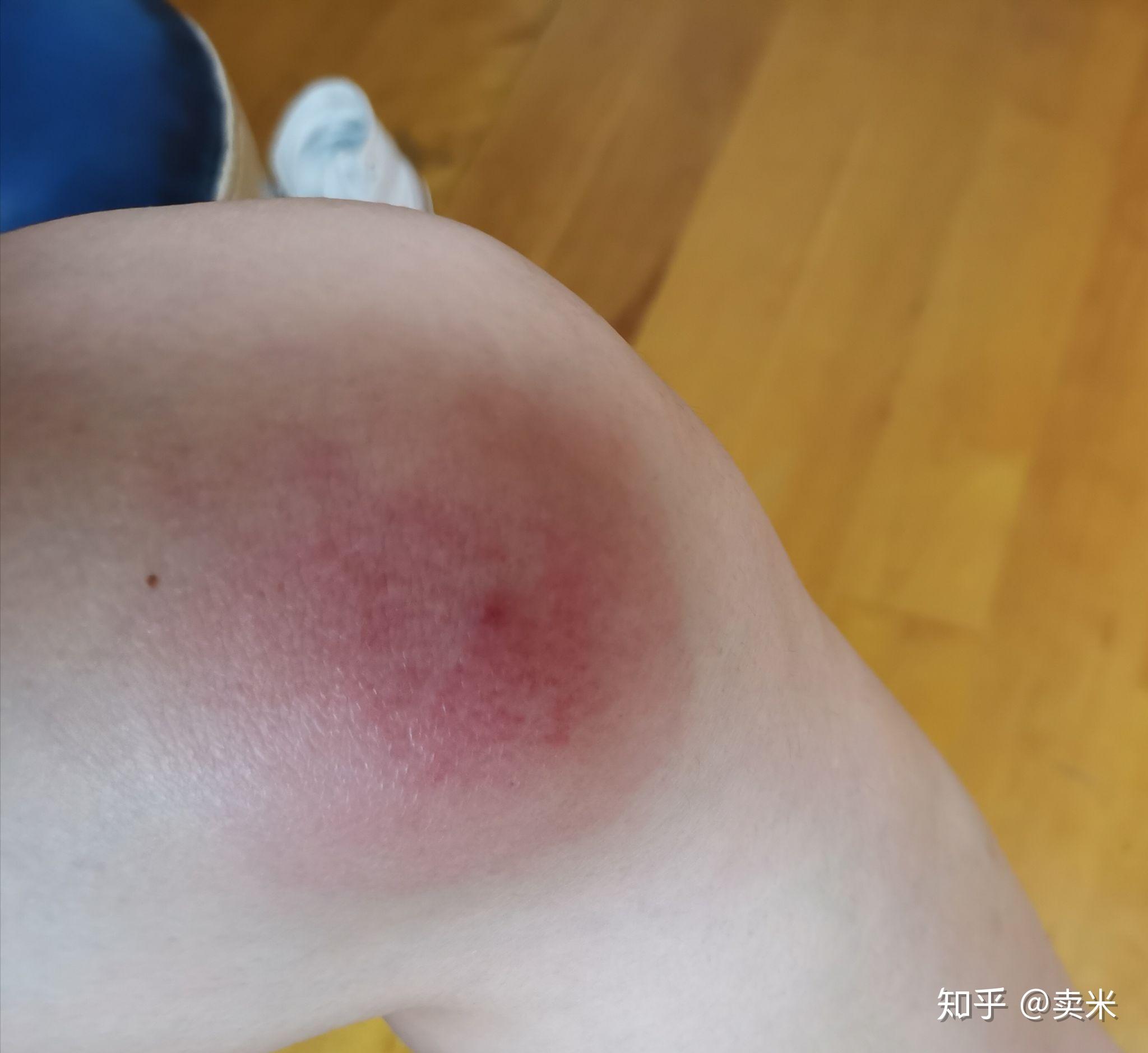 被蚊子叮咬之后肿得很严重一个星期左右才会消肿变成紫红色淤血癍块